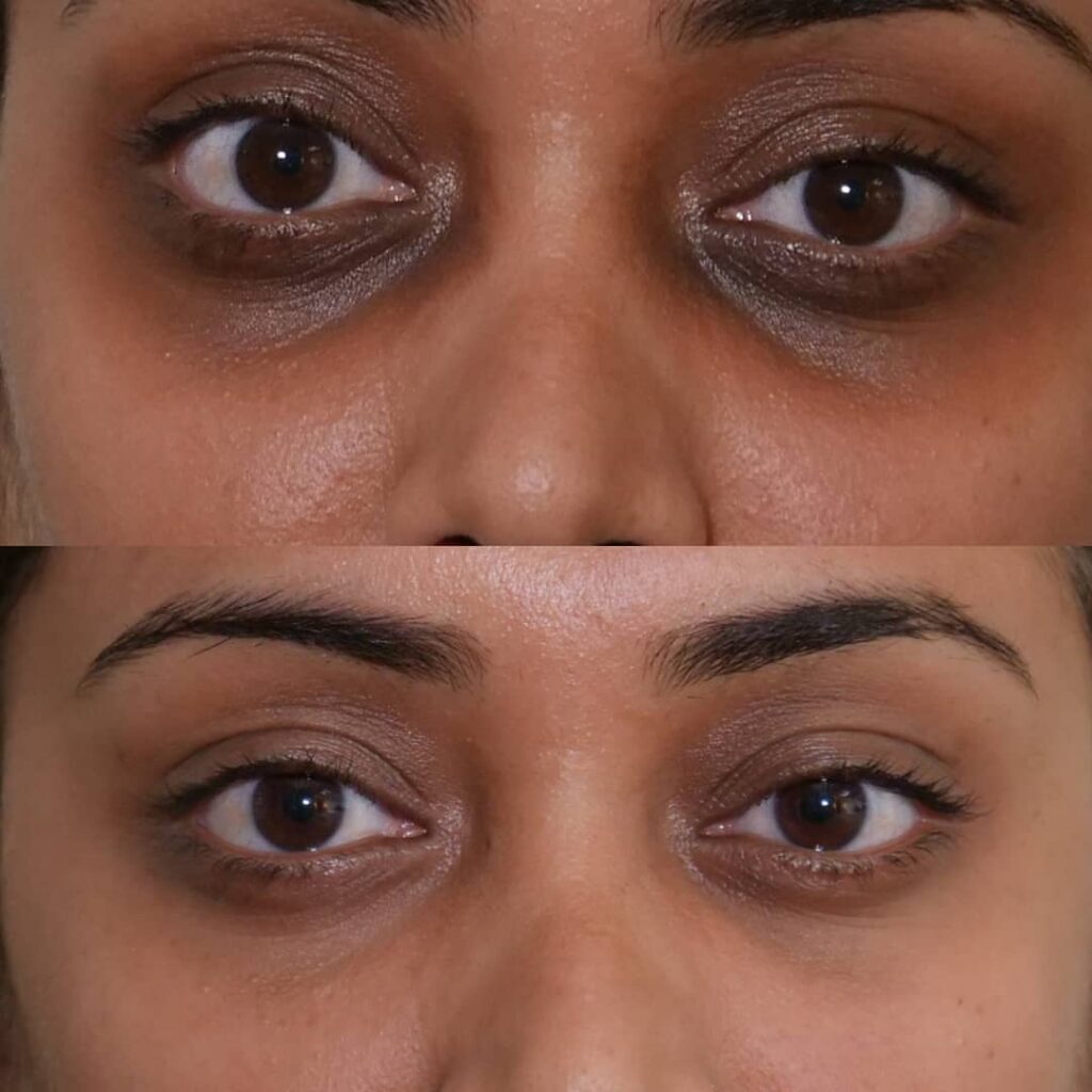 Me Line Periorbital (Dark Circle) Treatment Sunnyside Skin Clinic